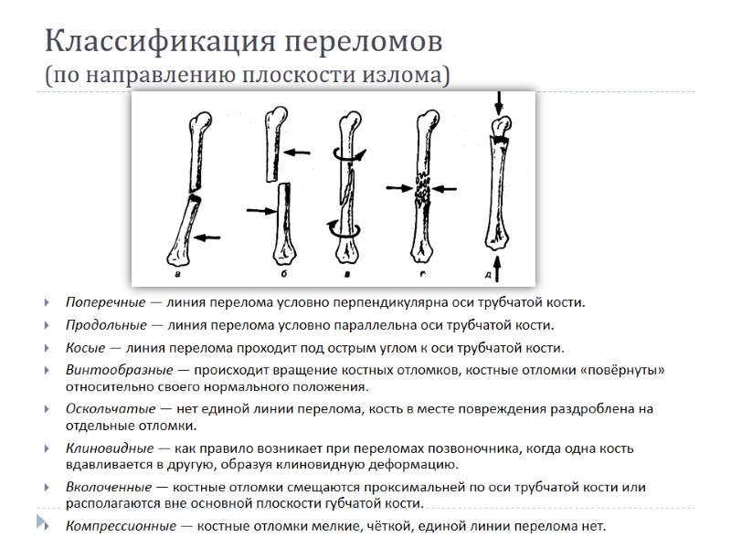 Классификация переломов  (по направлению плоскости излома) Поперечные — линия перелома условно перпендикулярна оси